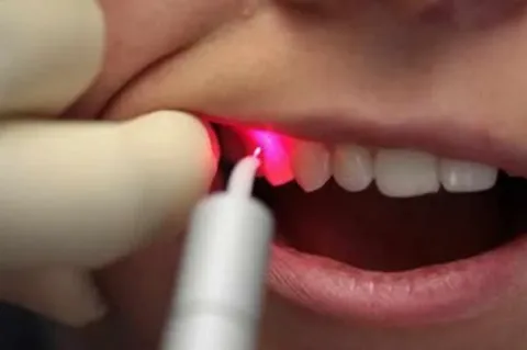 laser dental treatment in nizamabad